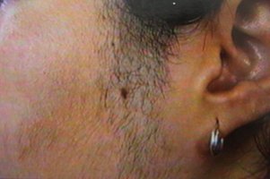 Vóór de behandeling