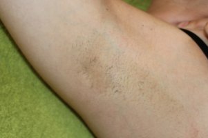 Geresulteerde oksel na meerdere IPL-behandelingen bij Amero Skin