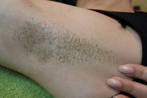 oksel-onbehandeld - Vóór de behandeling