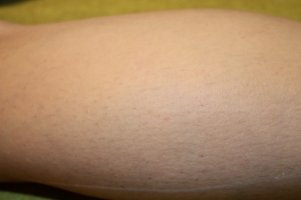 Bij een genezende wond of huidaandoening