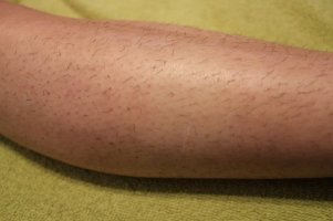 Onbehandeld onderbeen vóór de start van IPL-ontharingsbehandeling