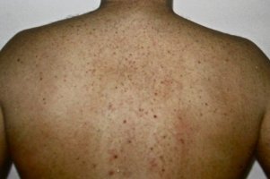 Geresulteerde rug na meerdere IPL-ontharingsbehandelingen bij Amero Skin