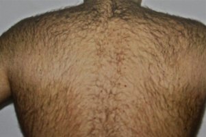 Onbehandelde rug vóór de start van de IPL-ontharingsbehandeling